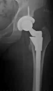 hip replacement
