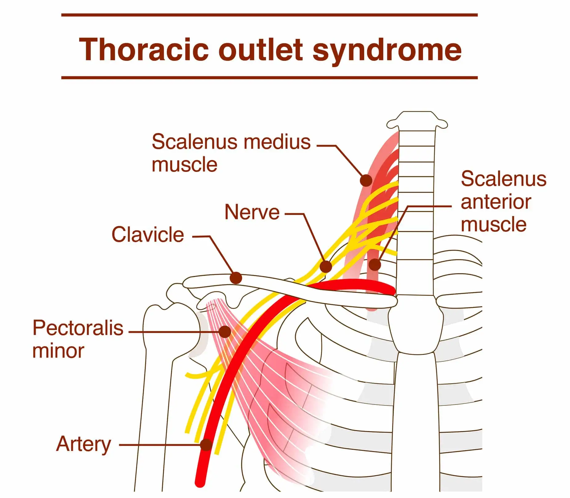 Pectoralis Minor Syndrome