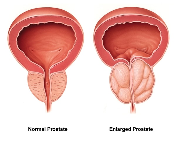 Comparison of normal and enlarged prostate